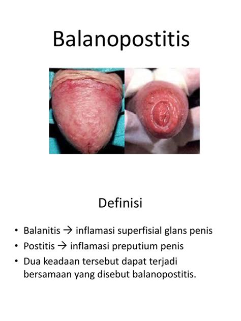 balanoposthitis reddit